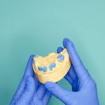 Prothese op implantaten: de moderne oplossing voor een stabiel gebit